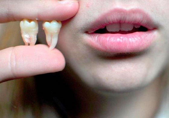 Можно ли удалить несколько зубов мудрости одновременно?