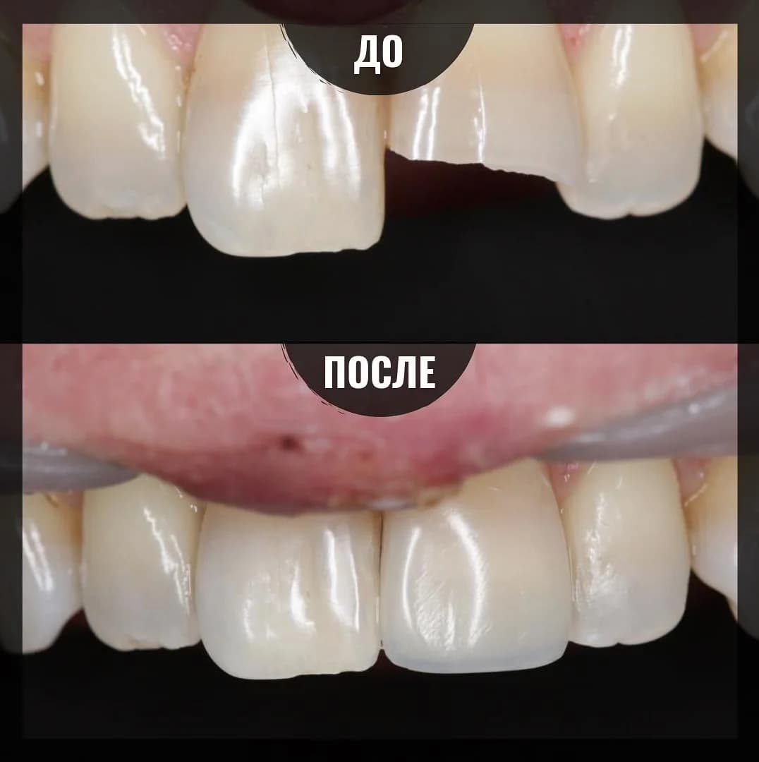 Откололся передний зуб. Как его можно восстановить?