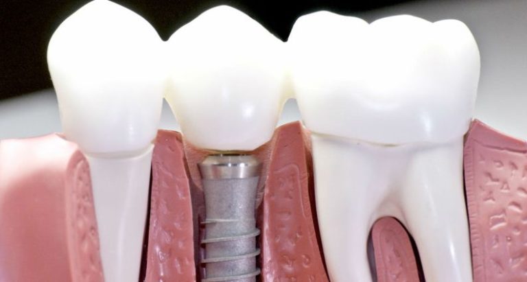 Временная имплантация зубов