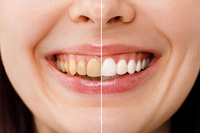 Как отбелить зубы быстро и без вреда для эмали в домашних условиях?